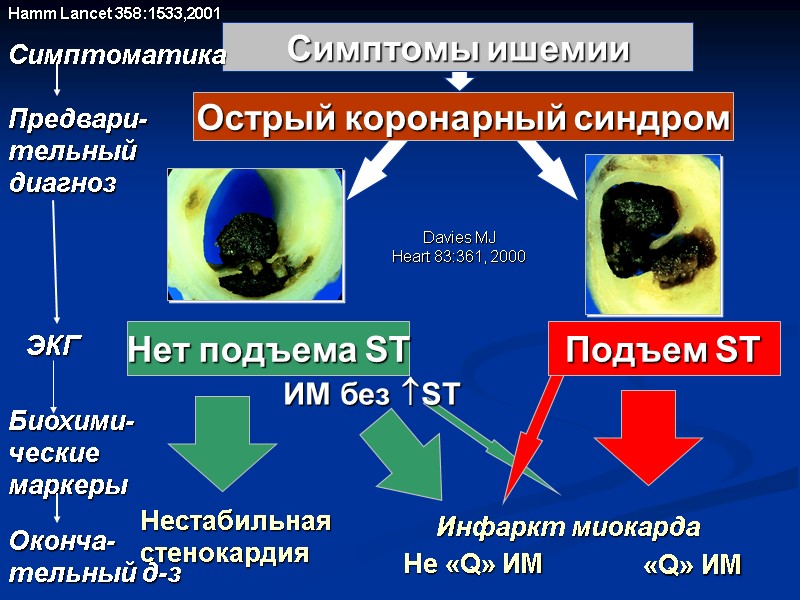 Нет подъема ST  Подъем ST Острый коронарный синдром Нестабильная стенокардия Не «Q» ИМ